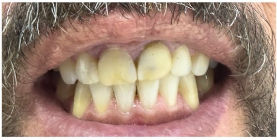 Antes das lentes, escurecimento dental