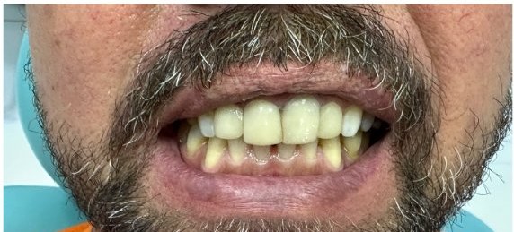 Depois das lentes, sorriso renovado
