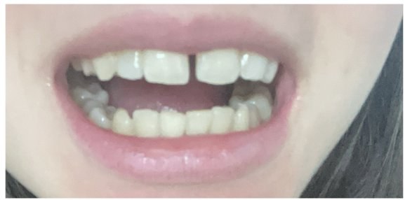 Antes das lentes, com espaço entre os dentes