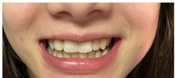 Depois das lentes, espaço fechado