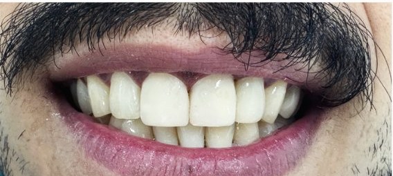 Depois das lentes, sorriso luminoso